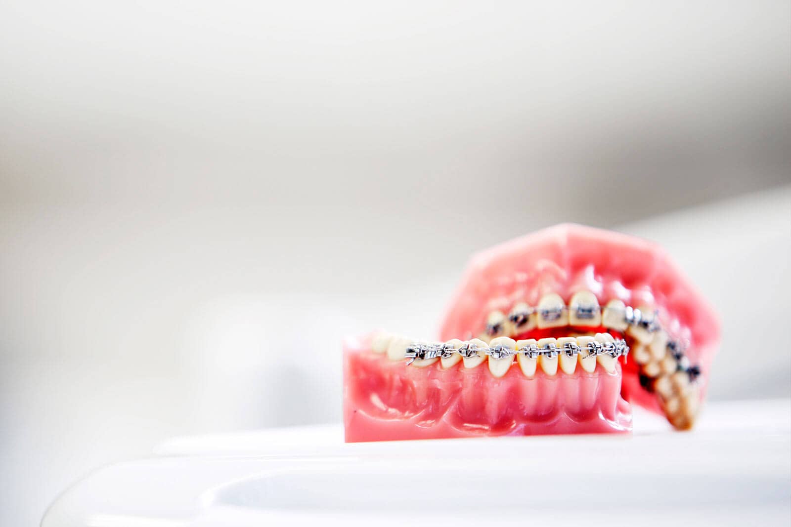 Denture model with fixed braces