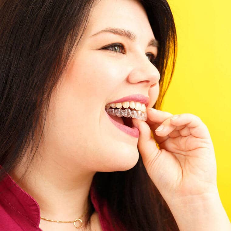 Invisible braces