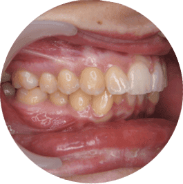 Photo of the bit before treatment