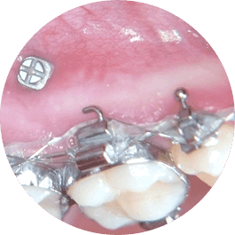 Mini screw