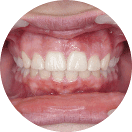 Sealed teeth
