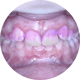 Tooth cleaning